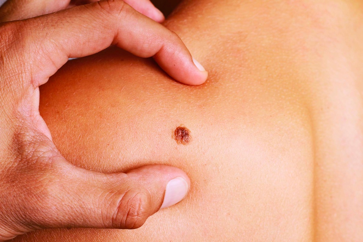 a hand isolating a cancerous mole